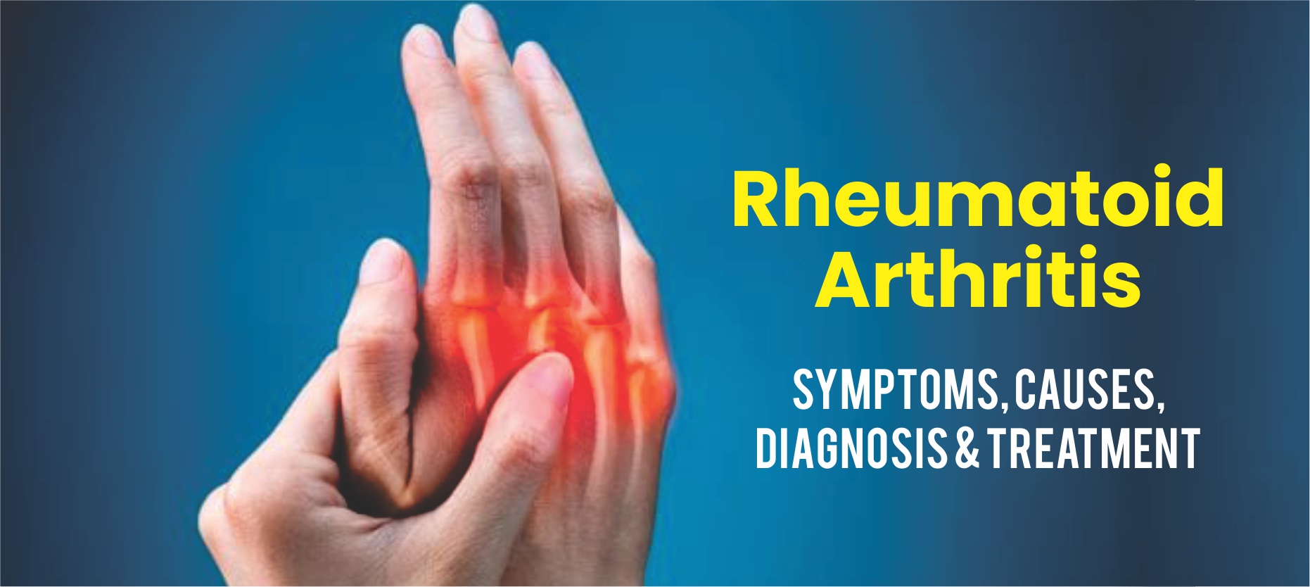Rheumatoid Arthritis – An Autoimmune Disorder?