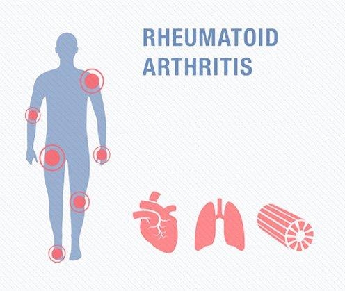 Rheumatoid Arthritis - An Autoimmune Disorder? - MedPlus Mart