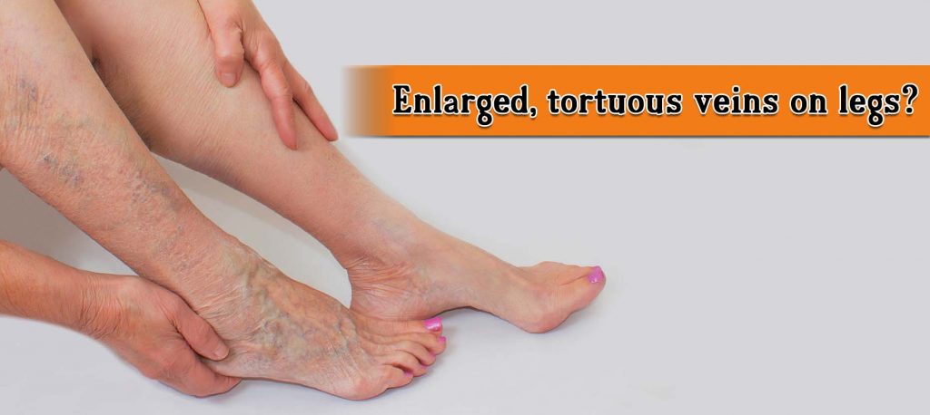 Enlarged, tortuous veins on legs | MedPlusMart