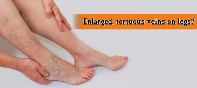 Enlarged, tortuous veins on legs?