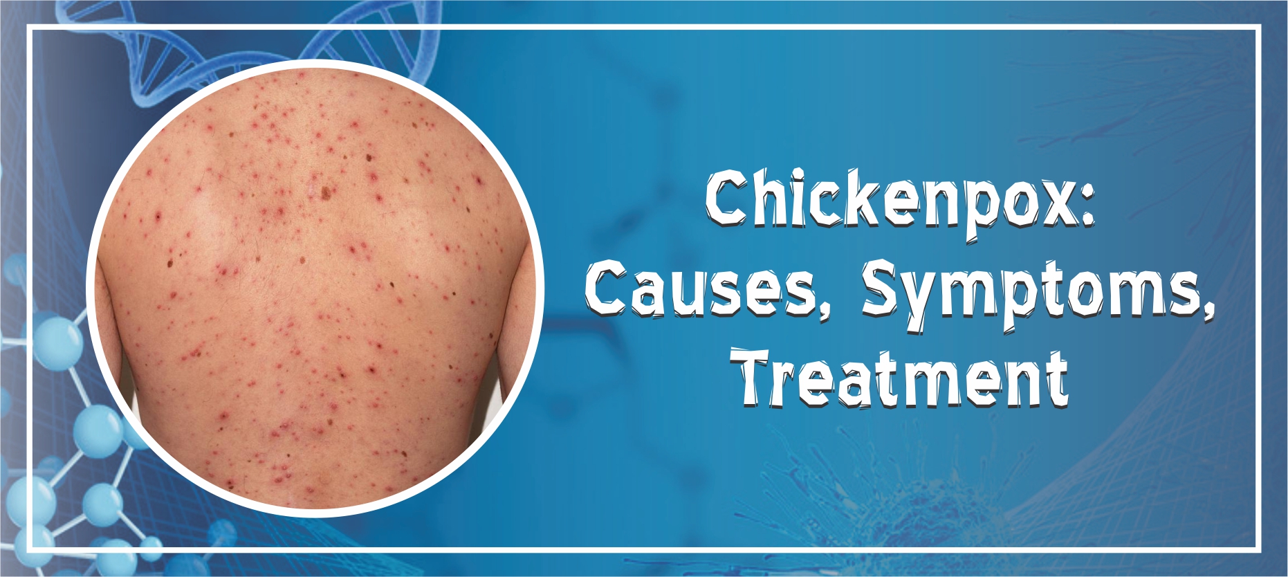 Chickenpox – Causes, Transmission, Signs & Treatment