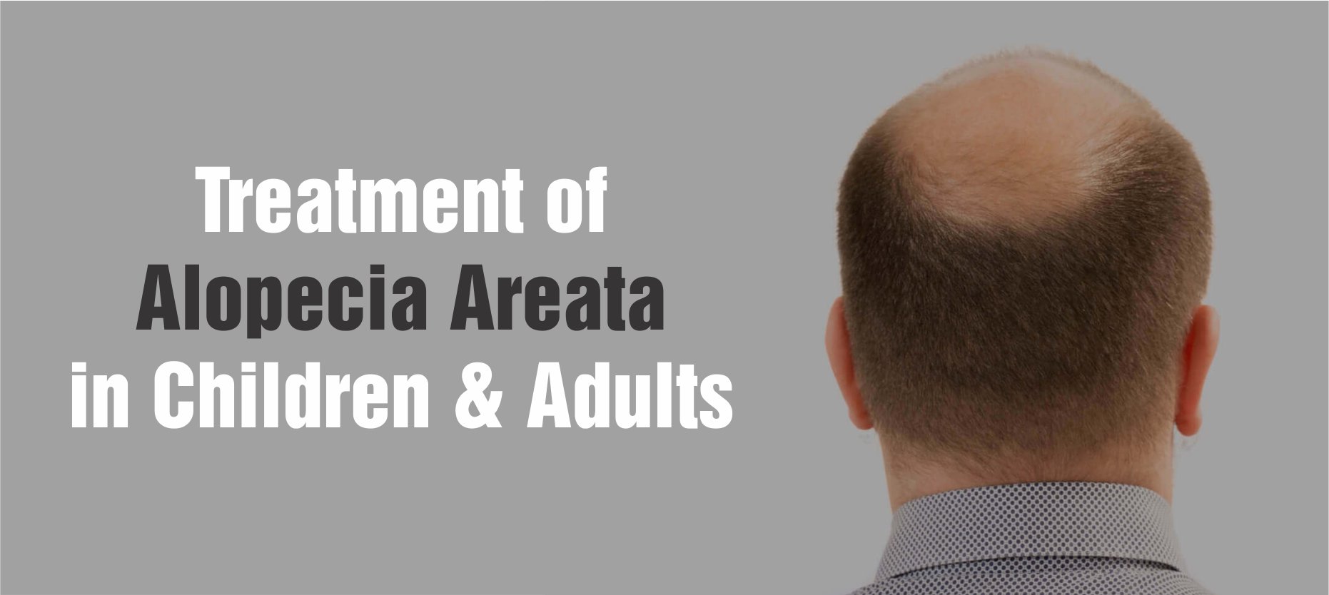 Best Ways To Treat Alopecia Areata