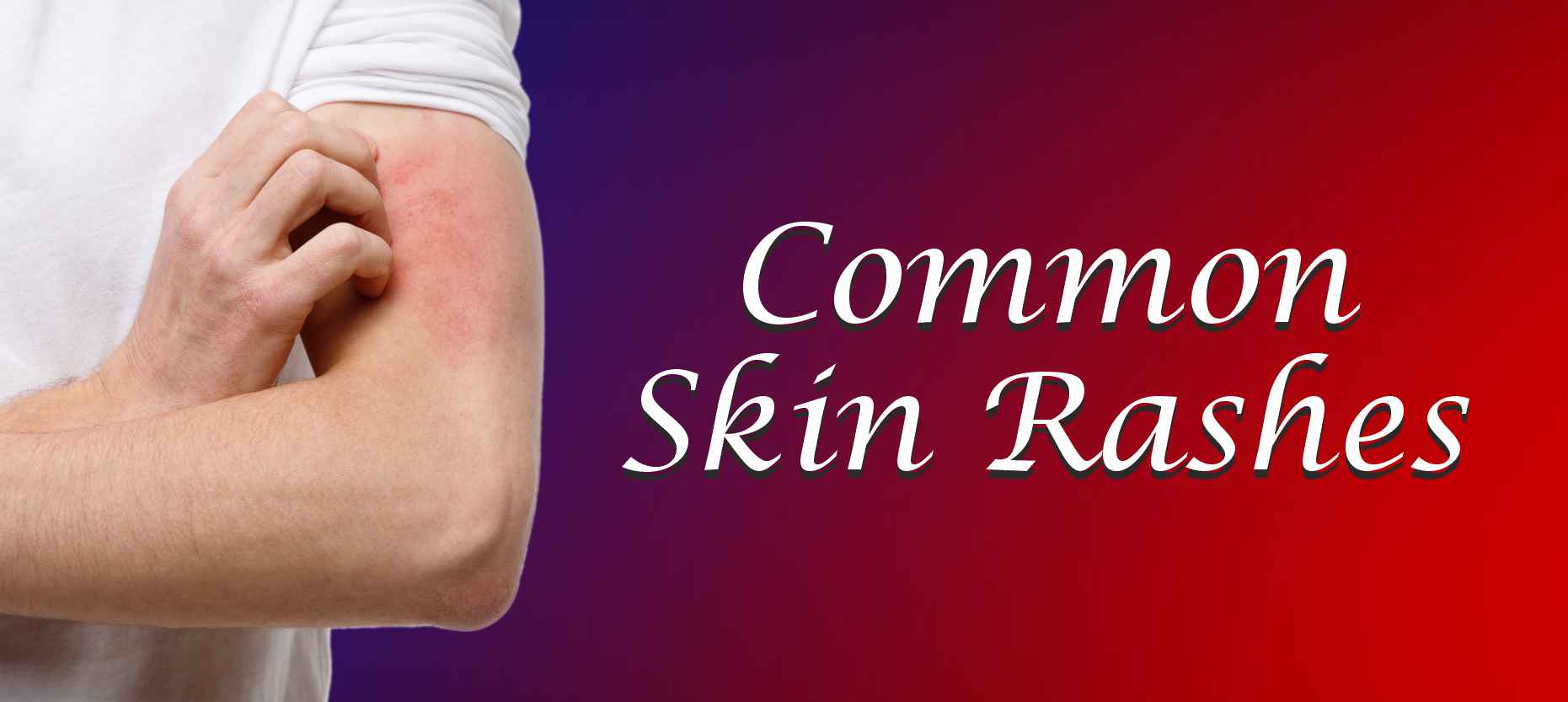 Skin Rashes Types Causes Diagnosis Treatment Skin Care MedPlusMart