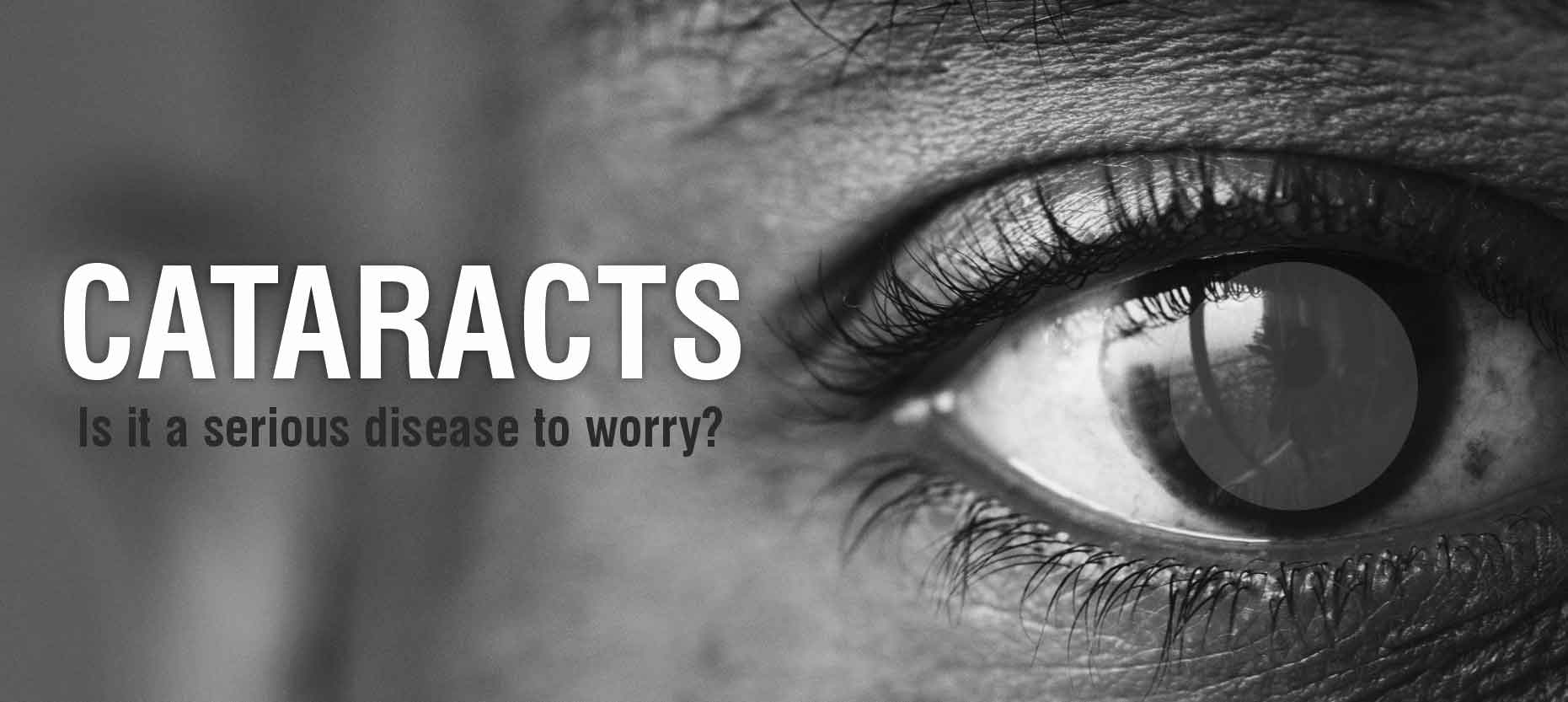 Cataracts: Is it a serious disease to worry?