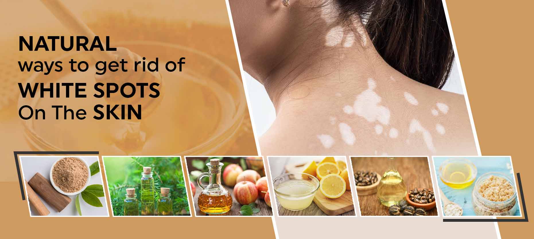 Natural Ways To Get Rid Of White Spots On Skin