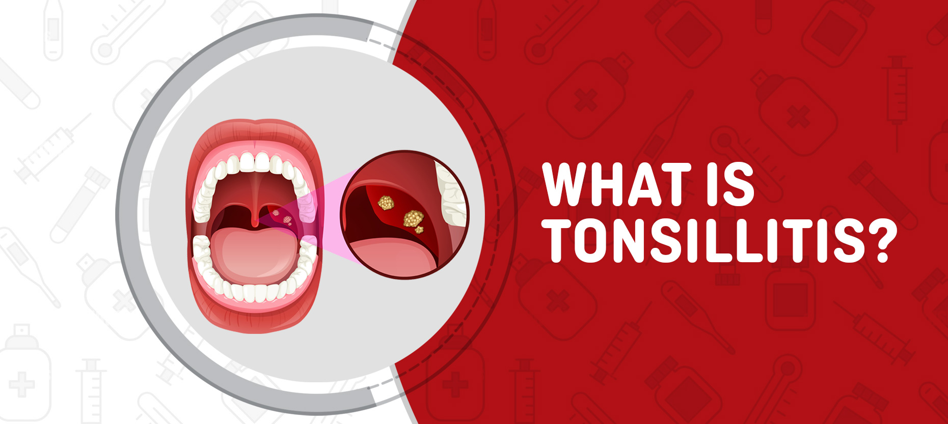 What is Tonsillitis? Symptoms & Treatment