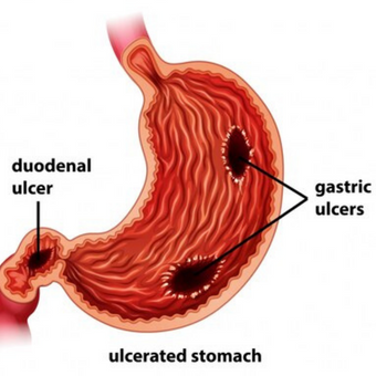 Ulcered Stomach