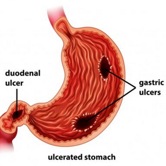 Digestive System Disorders: Peptic Ulcers, Diarrhoea, Jaundice