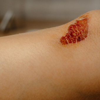 wound healing