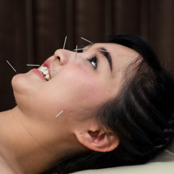accupuncture on nervous system