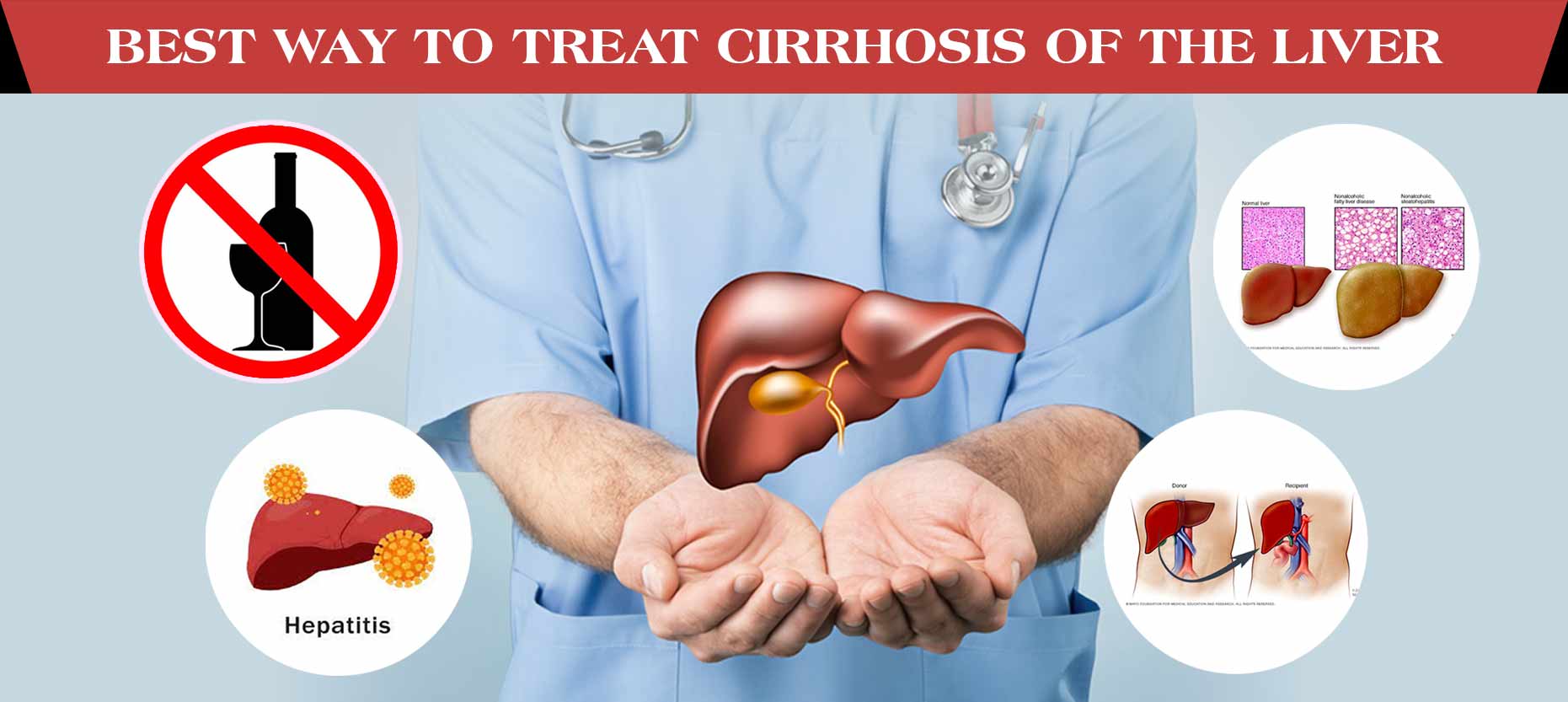 Best Way to Treat Cirrhosis of the Liver