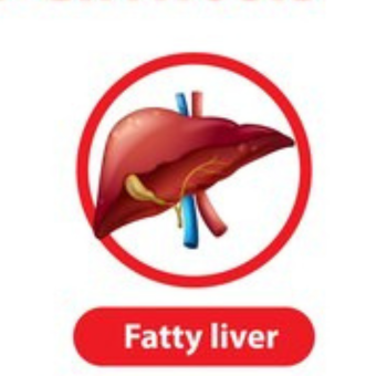 fatty liver treat