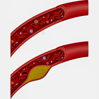 Aids in lowering cholesterol