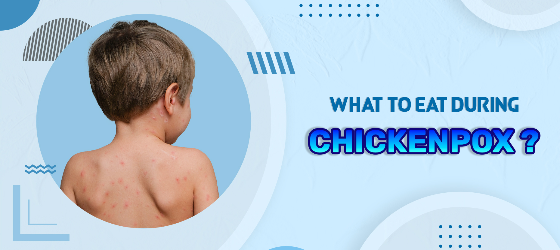 Easy Home Diet Plan for Chickenpox Recovery Easy Home Diet Plan for Chickenpox Recovery